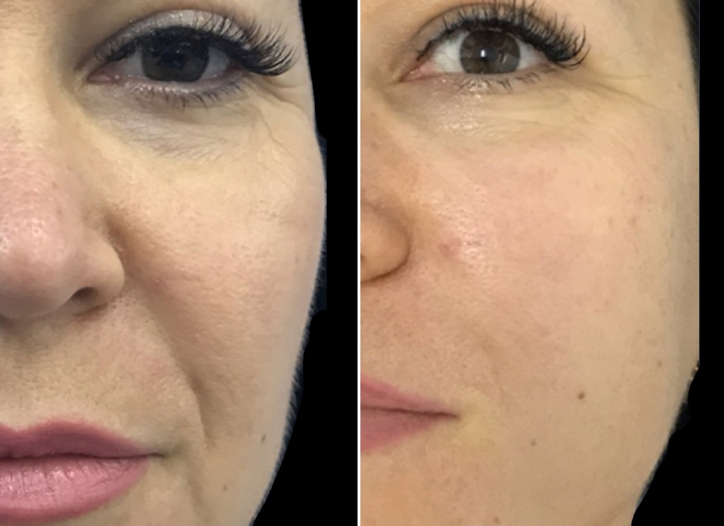 HydroVerstand after two treatments visual at Science of Beauty Annapolis
